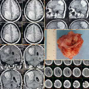 neuro-surgeon-in-ghodbunder-road