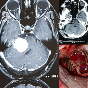 Brain-and-spine-surgeon-in-thane