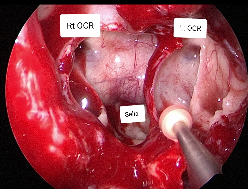 Spine-Surgeon-in-Ghodbunder-Road